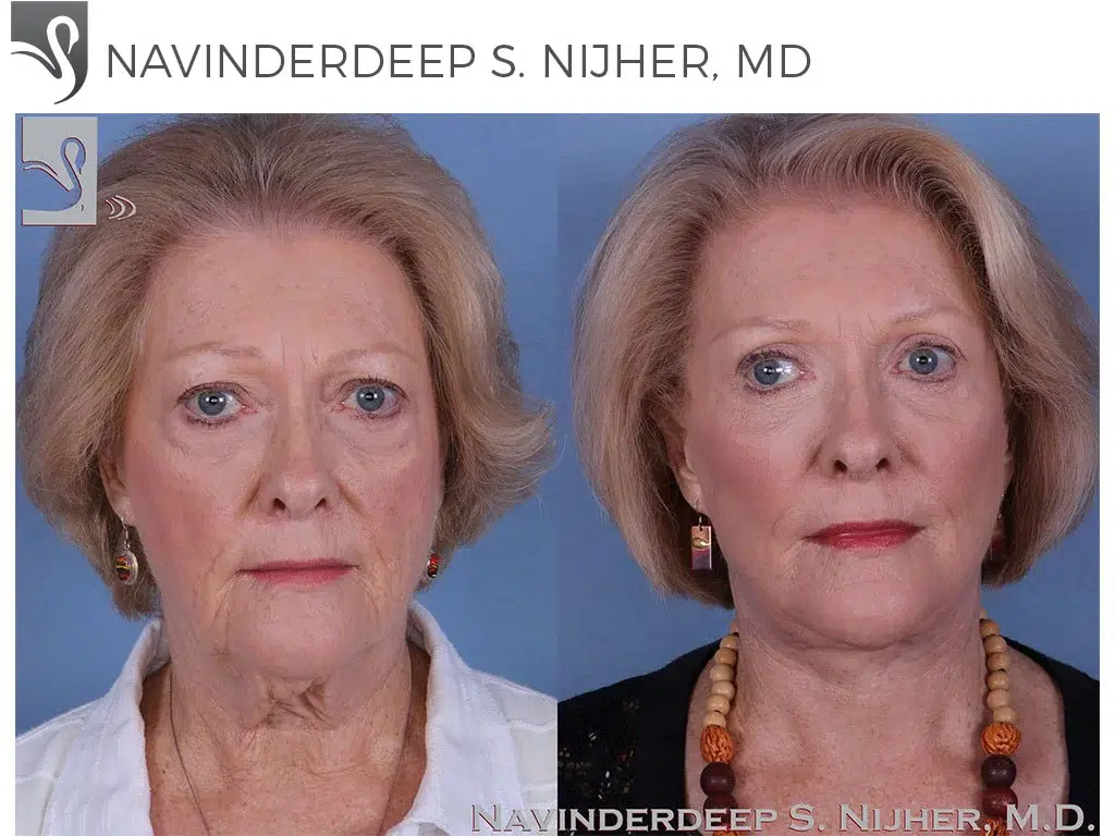 Before and After Image: Face Lift Case #57951 - front
