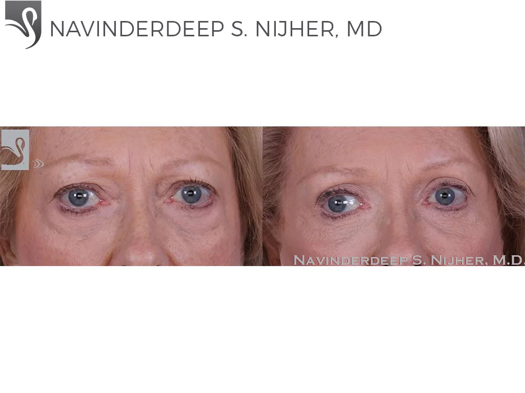 Before and After Image: Eyelid Surgery Case #57951 - front