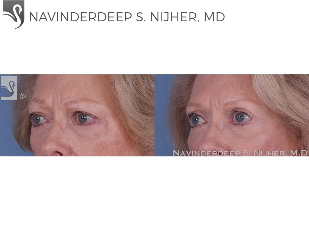 Before and After Image: Eyelid Surgery Case #57951 - left-front-oblique