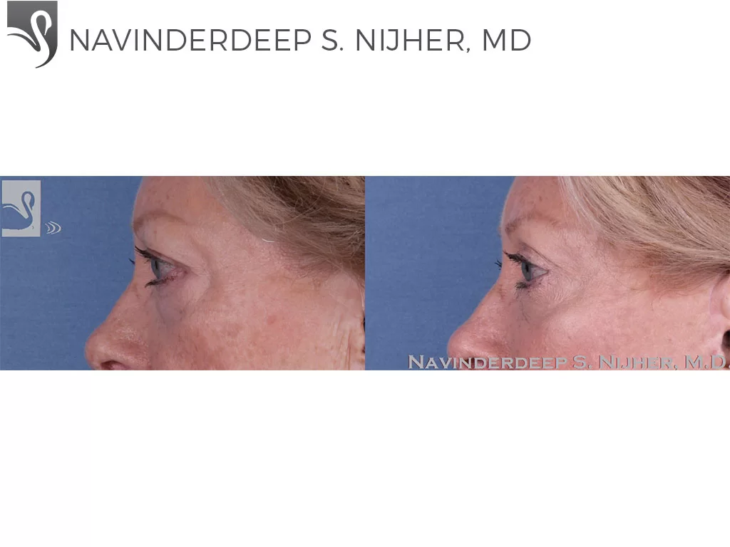 Before and After Image: Eyelid Surgery Case #57951 - left-side