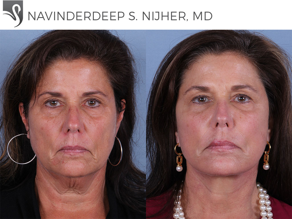 Before and After Image: Face Lift Case #58188 - front