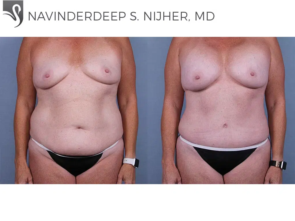 Before and After Image: Abdominoplasty (Tummy Tuck) Case #58205 - front