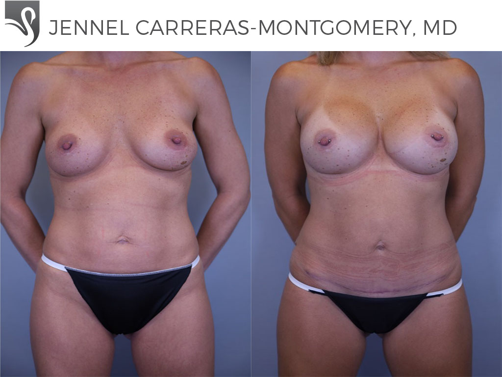 Before and After Image: Mommy Makeover Case #58216 - front