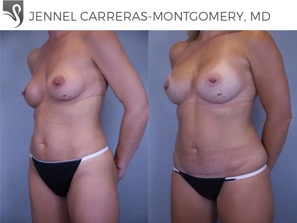 Before and After Image: Mommy Makeover Case #58216 - left-front-oblique