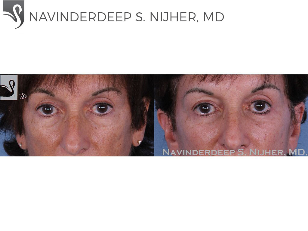 Before and After Image: Eyelid Surgery Case #58359 - front