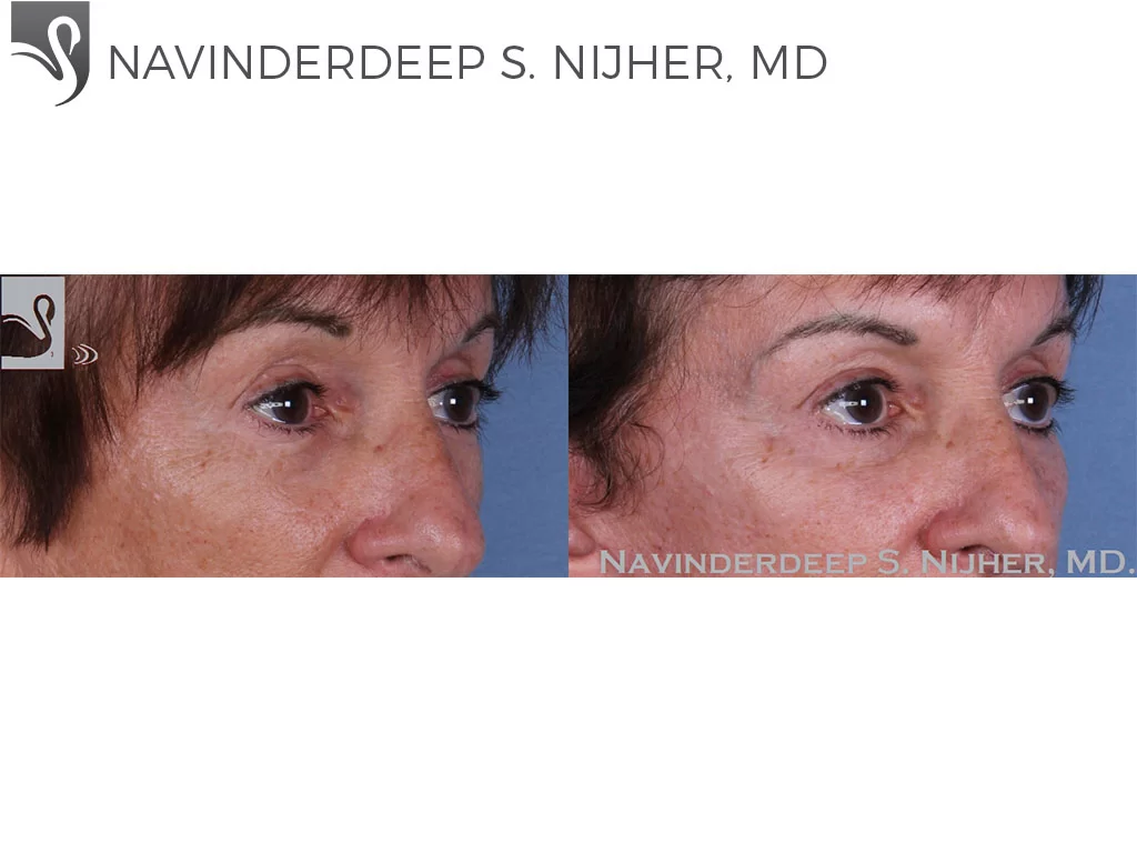 Before and After Image: Eyelid Surgery Case #58359 - right-front-oblique