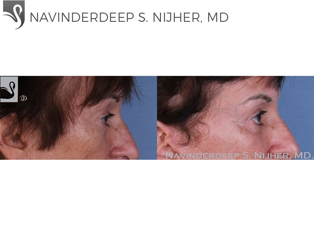 Before and After Image: Eyelid Surgery Case #58359 - right-side