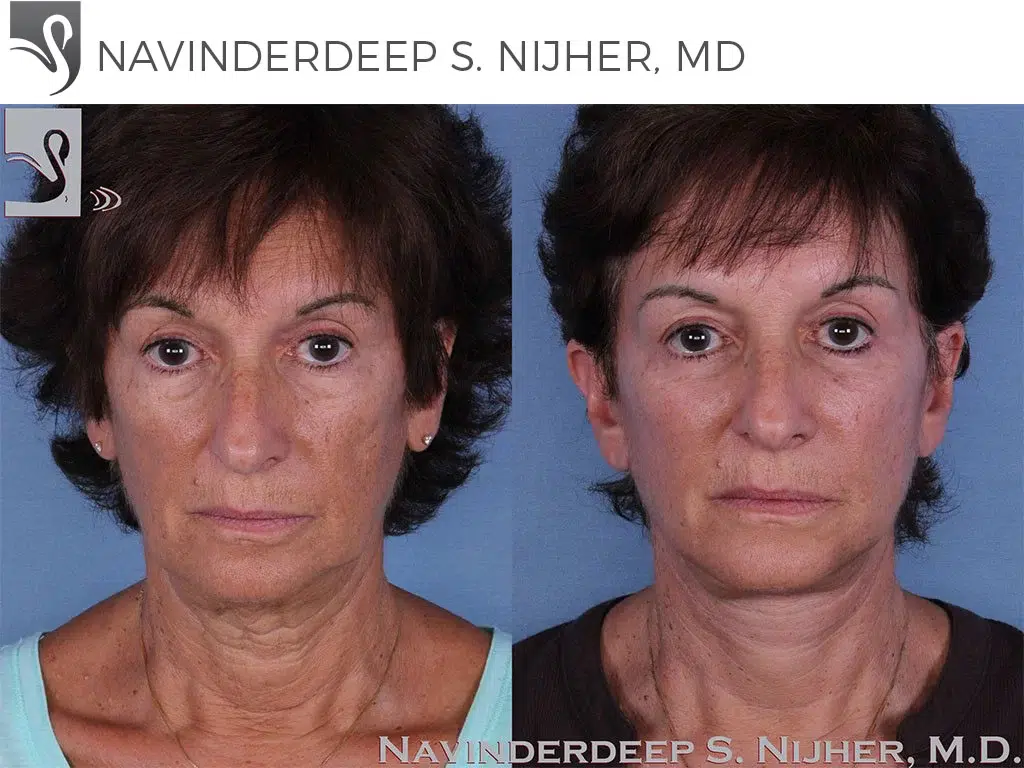 Before and After Image: Face Lift Case #58359 - front