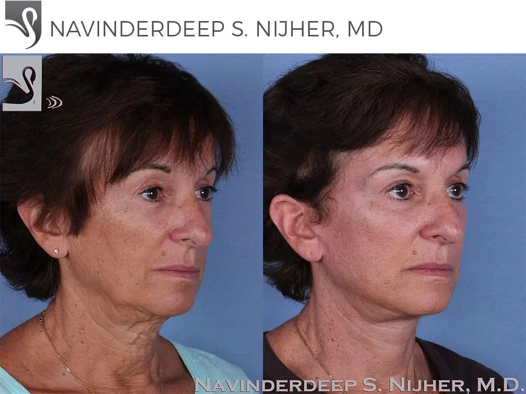 Before and After Image: Face Lift Case #58359 - right-front-oblique