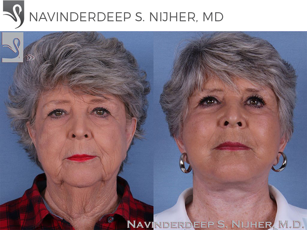 Before and After Image: Face Lift Case #58375 - front