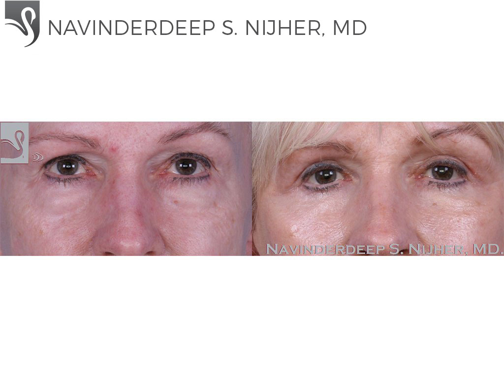 Before and After Image: Eyelid Surgery Case #58616 - front
