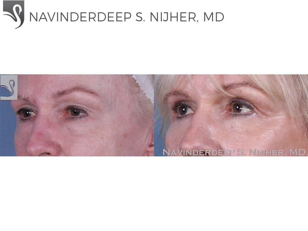 Before and After Image: Eyelid Surgery Case #58616 - left-front-oblique