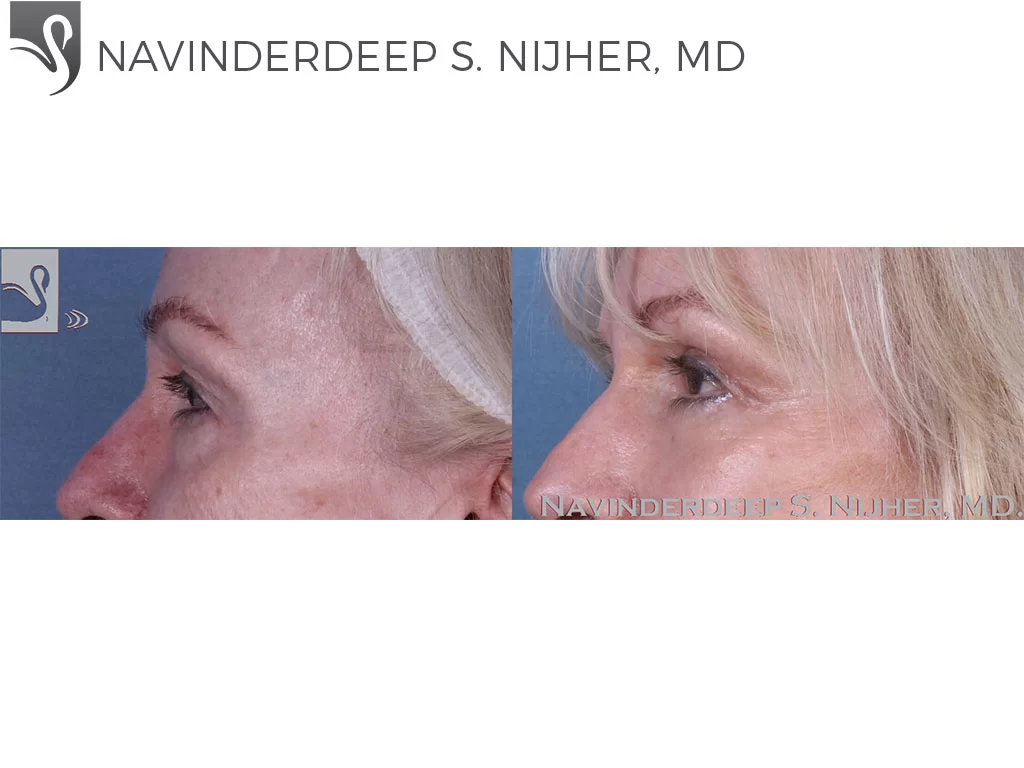 Before and After Image: Eyelid Surgery Case #58616 - left-side