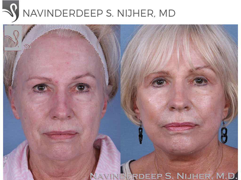 Before and After Image: Face Lift Case #58616 - front