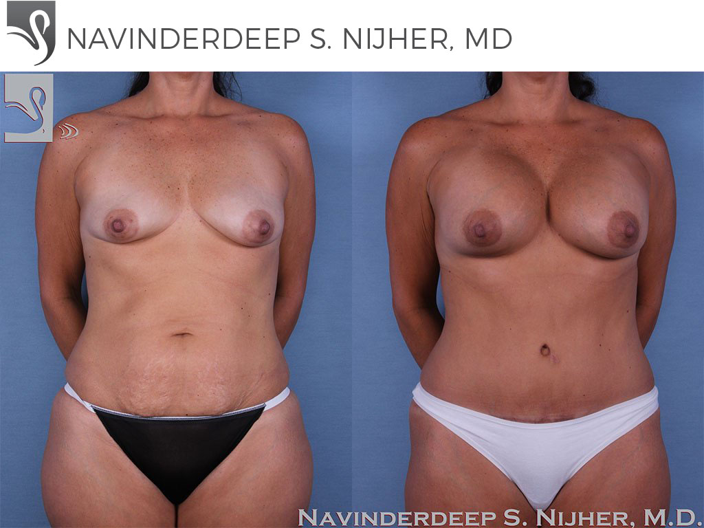 Before and After Image: Mommy Makeover Case #58618 - front