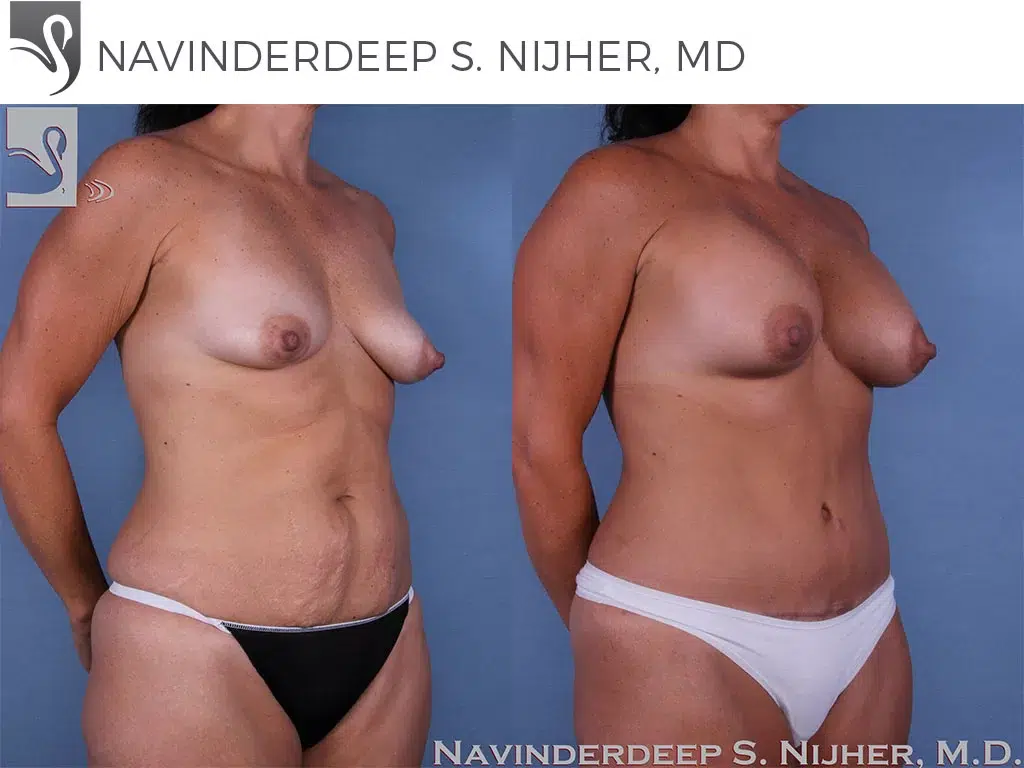 Before and After Image: Mommy Makeover Case #58618 - right-front-oblique