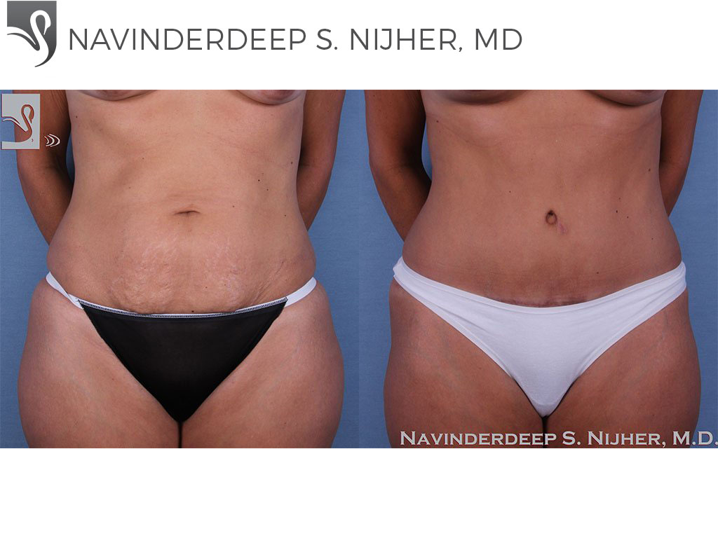 Before and After Image: Abdominoplasty (Tummy Tuck) Case #58618 - front