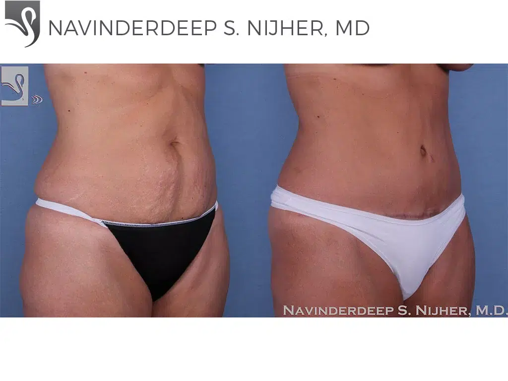 Before and After Image: Abdominoplasty (Tummy Tuck) Case #58618 - right-front-oblique