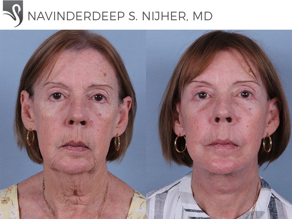 Before and After Image: Face Lift Case #58828