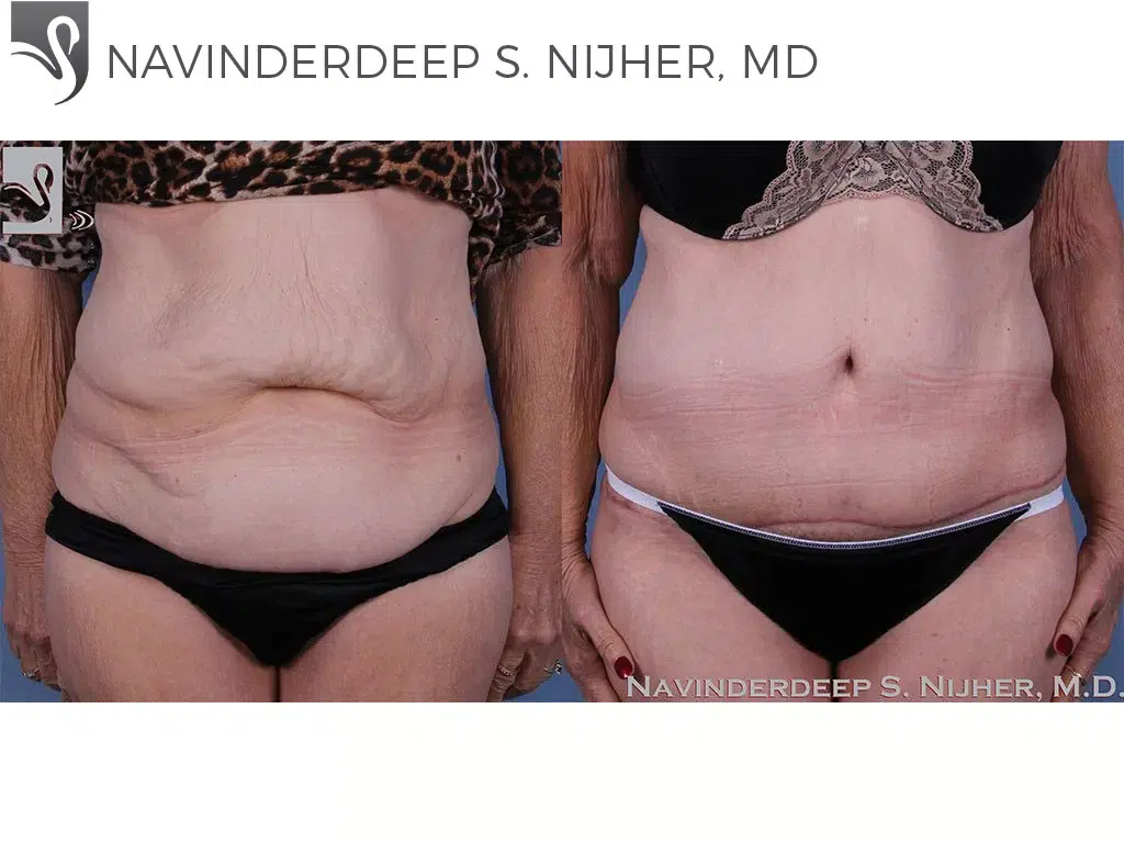 Before and After Image: Abdominoplasty (Tummy Tuck) Case #58980 - front