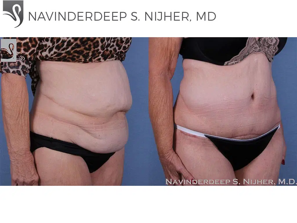 Before and After Image: Abdominoplasty (Tummy Tuck) Case #58980 - right-front-oblique