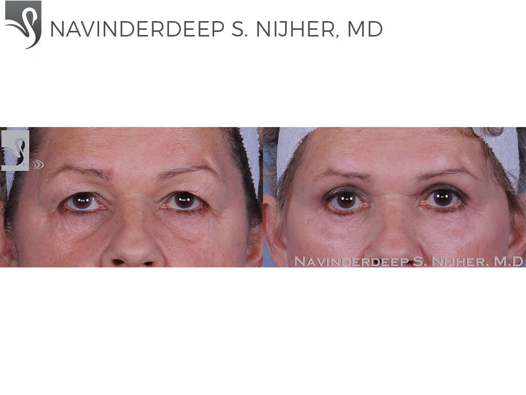 Before and After Image: Eyelid Surgery Case #59409 - front