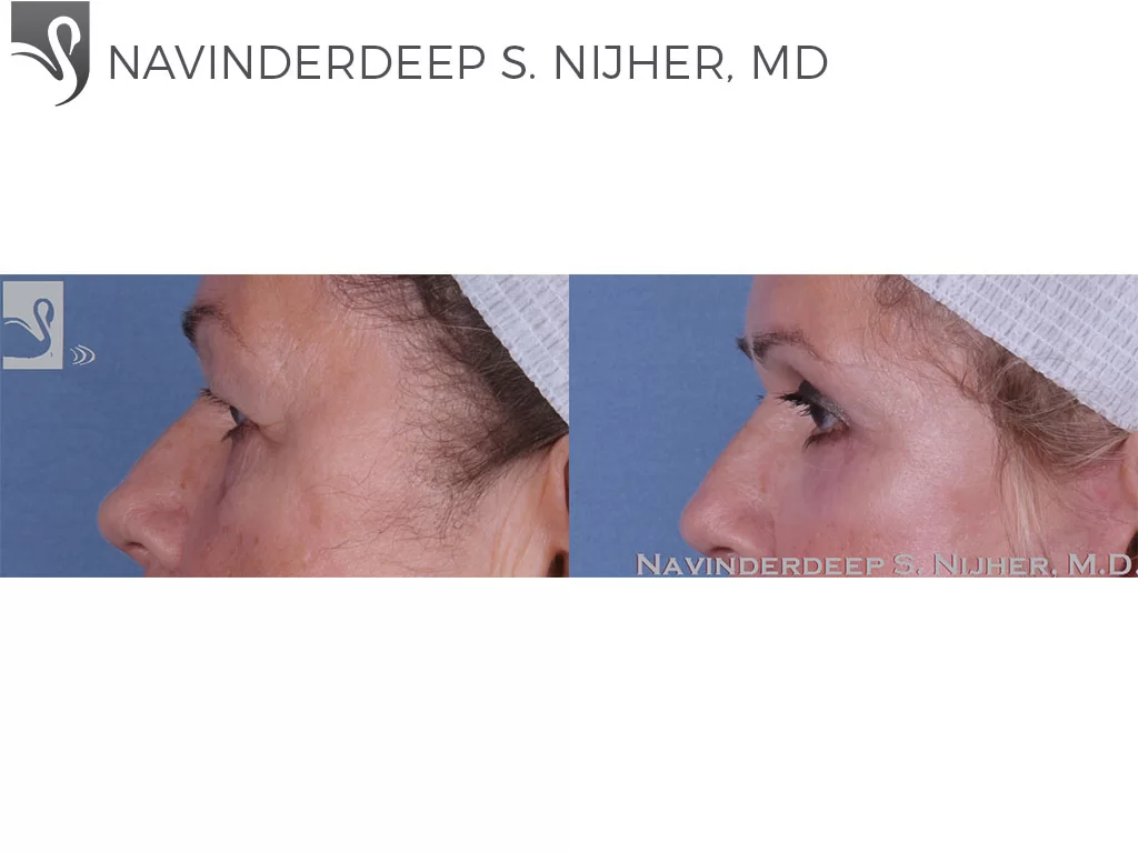 Before and After Image: Eyelid Surgery Case #59409 - left-side