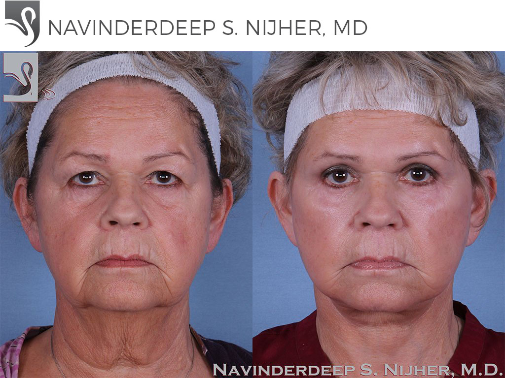 Before and After Image: Face Lift Case #59409 - front