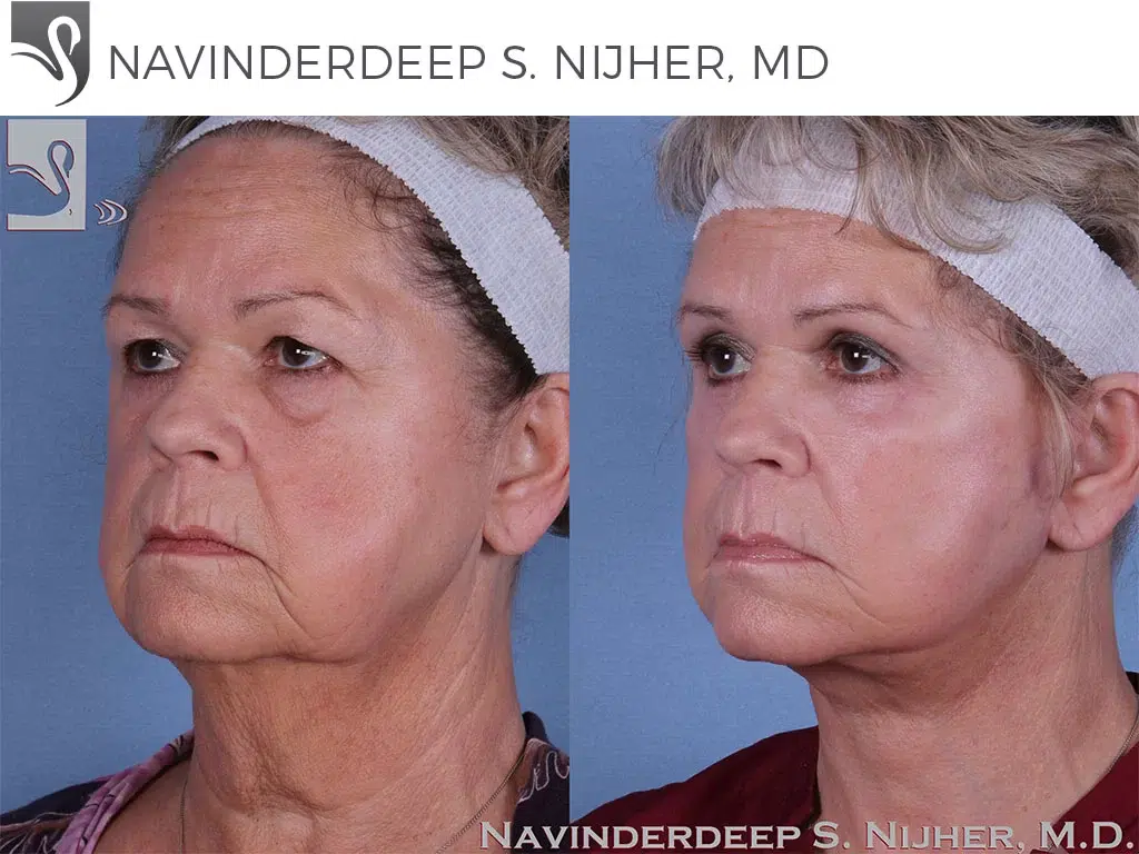 Before and After Image: Face Lift Case #59409 - left-front-oblique