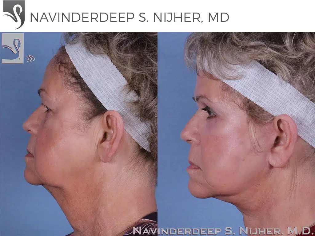 Before and After Image: Face Lift Case #59409 - left-side