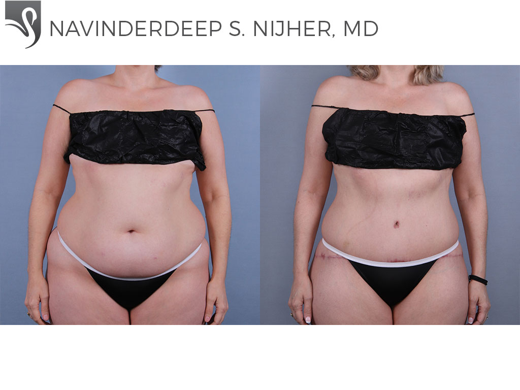 Before and After Image: Abdominoplasty (Tummy Tuck) Case #59418 - front