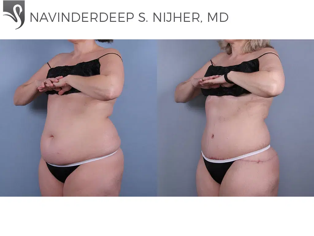 Before and After Image: Abdominoplasty (Tummy Tuck) Case #59418 - left-front-oblique