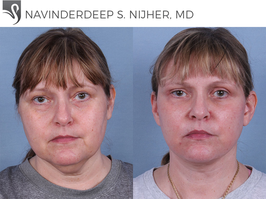 Before and After Image: Face Lift Case #59804 - front