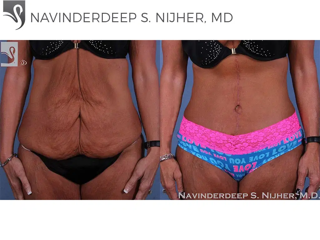 Before and After Image: Abdominoplasty (Tummy Tuck) Case #60008 - front