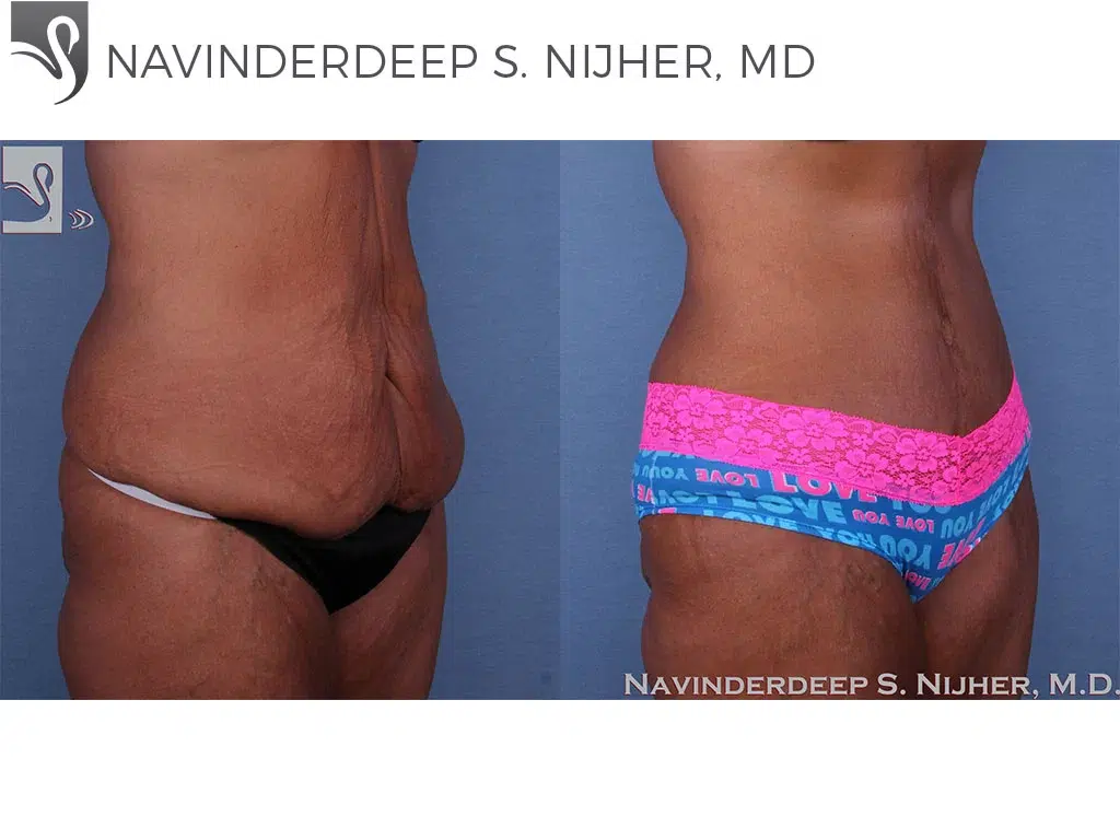 Before and After Image: Abdominoplasty (Tummy Tuck) Case #60008 - right-front-oblique