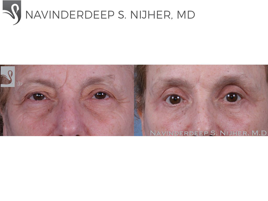 Before and After Image: Eyelid Surgery Case #60034 - front