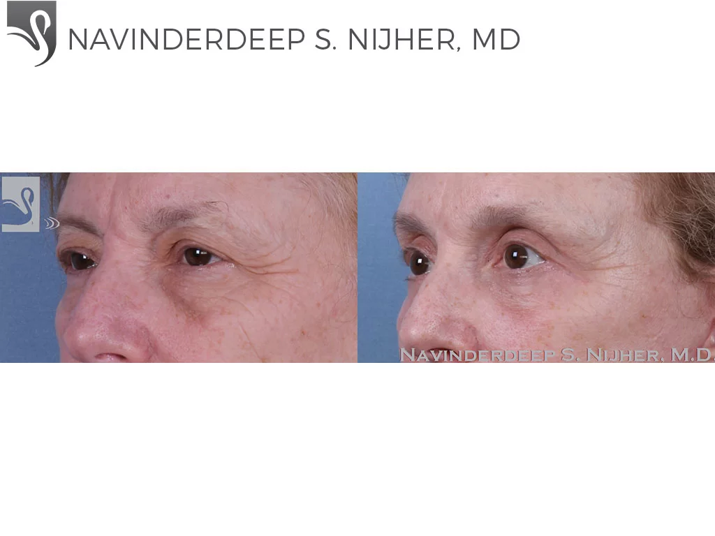 Before and After Image: Eyelid Surgery Case #60034 - left-front-oblique