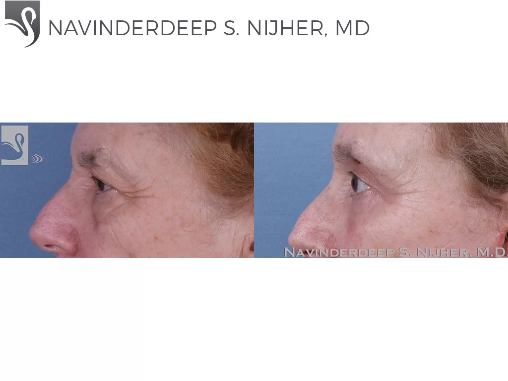 Before and After Image: Eyelid Surgery Case #60034 - left-side