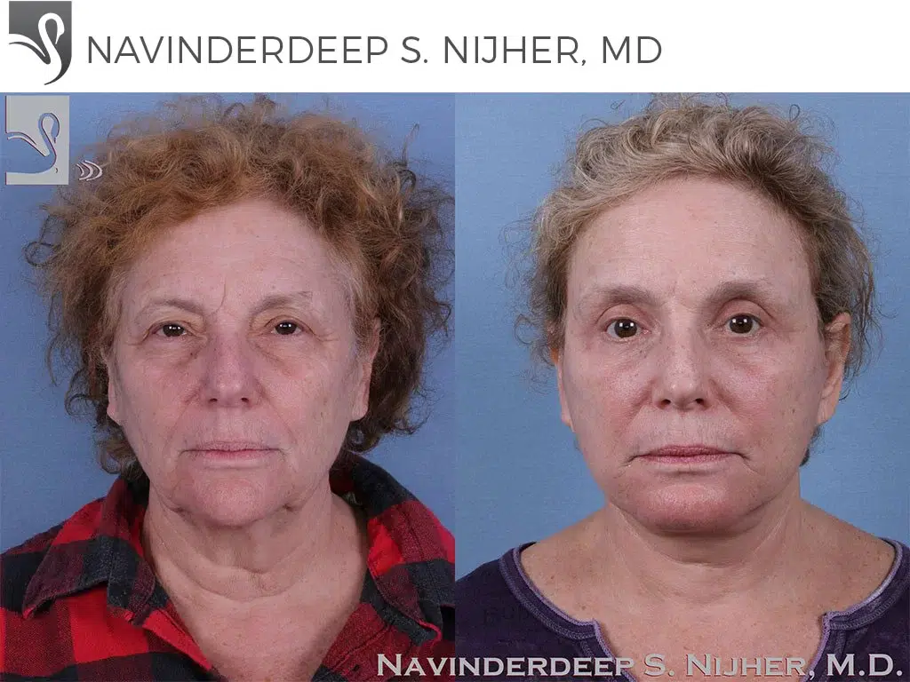 Before and After Image: Face Lift Case #60034 - front