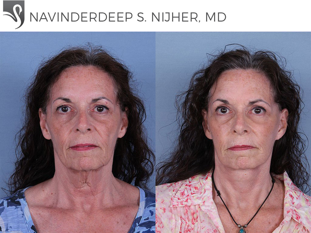 Before and After Image: Face Lift Case #60098 - front