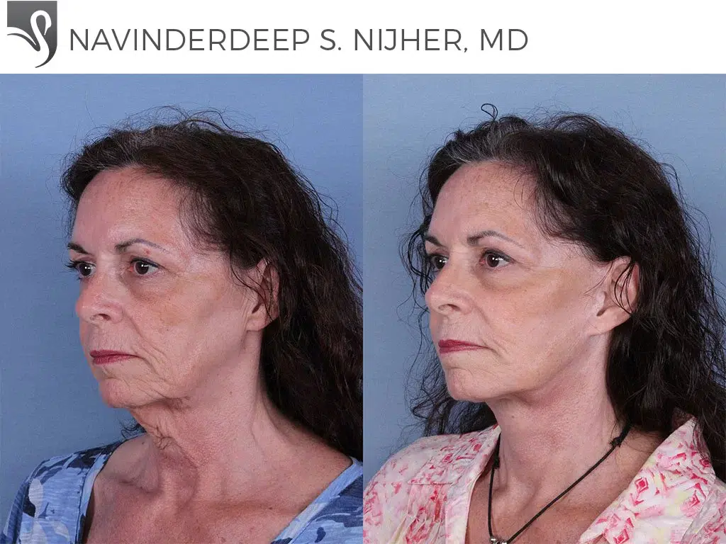 Before and After Image: Face Lift Case #60098 - left-front-oblique