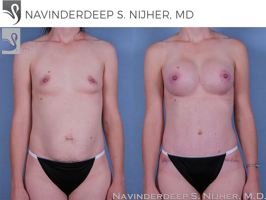 Before and After Image: Mommy Makeover Case #60351 - front