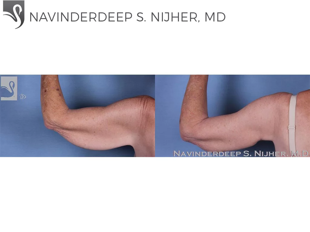 Before and After Image: Arm Lift Case #60452 - back