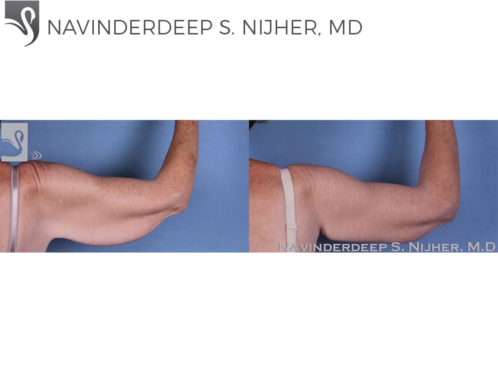 Before and After Image: Arm Lift Case #60452 - back