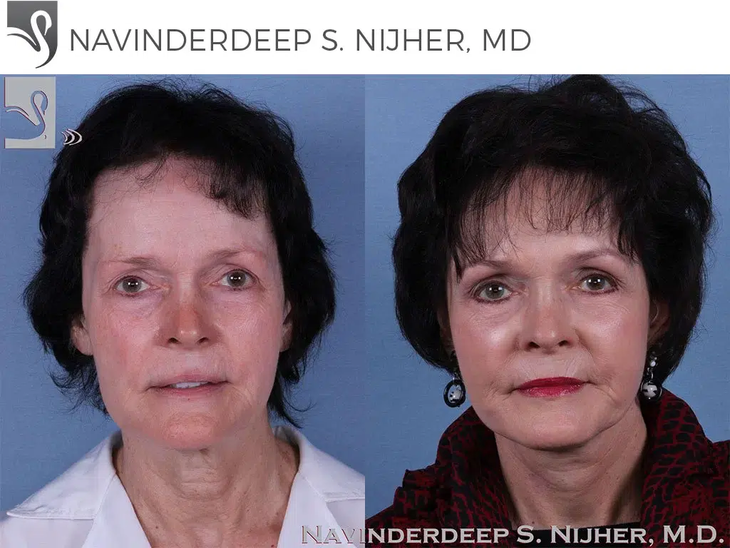 Before and After Image: Face Lift Case #60643 - front
