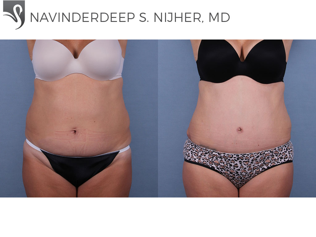 Before and After Image: Abdominoplasty (Tummy Tuck) Case #60697 - front