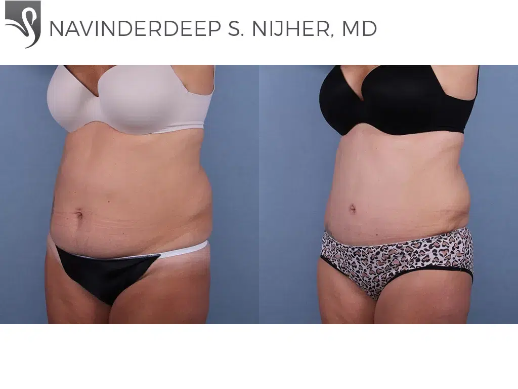 Before and After Image: Abdominoplasty (Tummy Tuck) Case #60697 - left-front-oblique