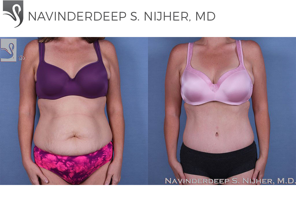Before and After Image: Abdominoplasty (Tummy Tuck) Case #60771 - front