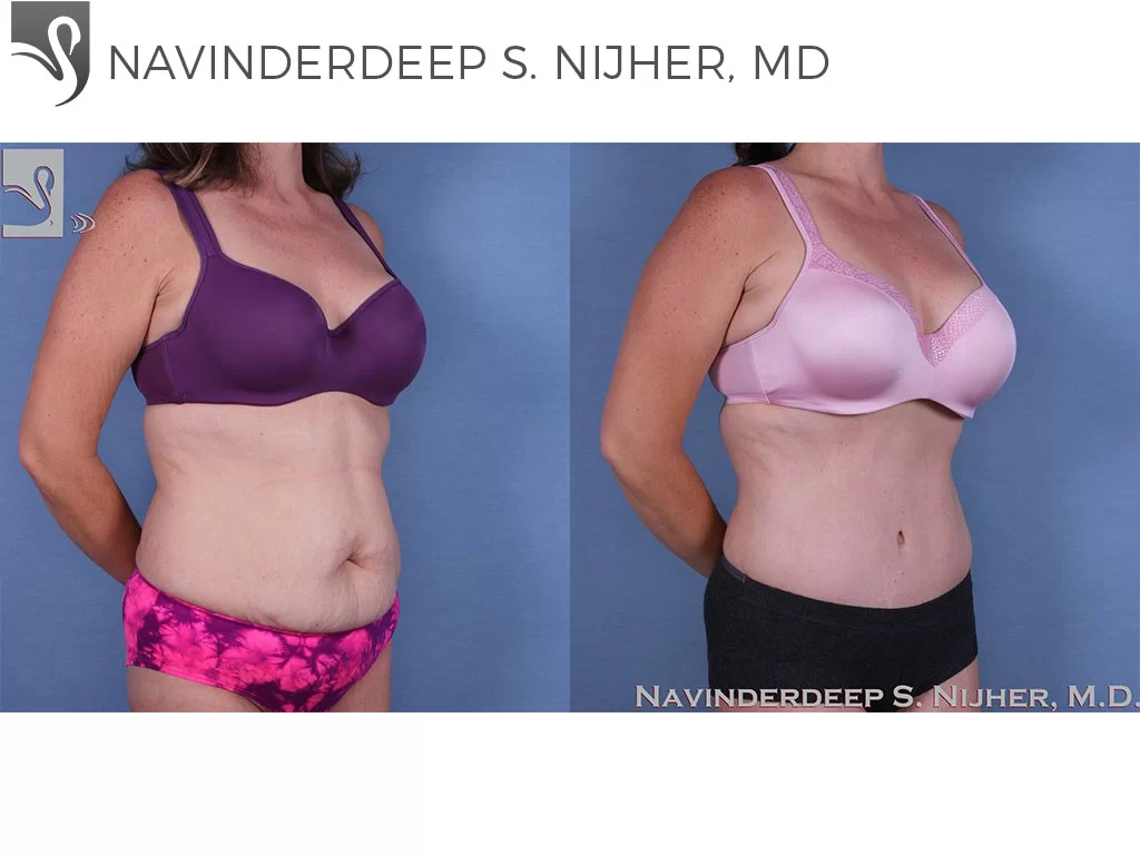 Before and After Image: Abdominoplasty (Tummy Tuck) Case #60771 - right-front-oblique