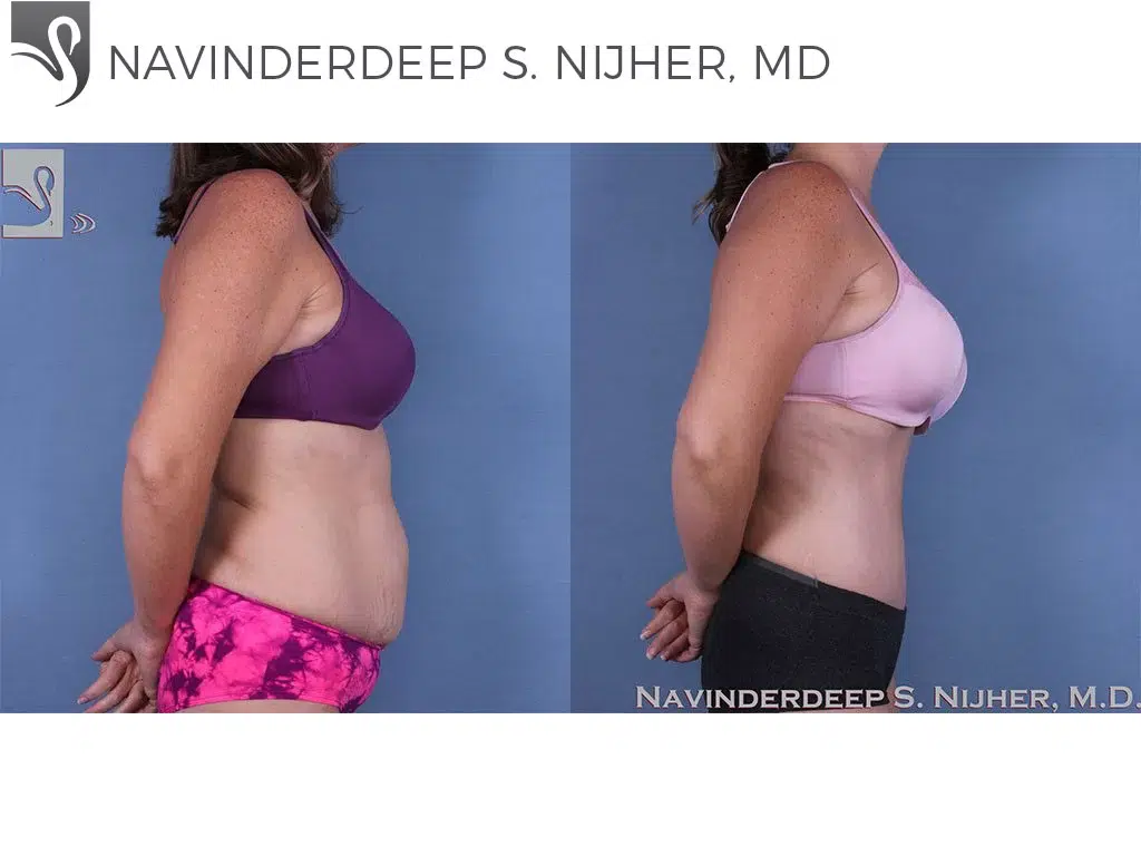 Before and After Image: Abdominoplasty (Tummy Tuck) Case #60771 - right-side